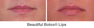 botox-08