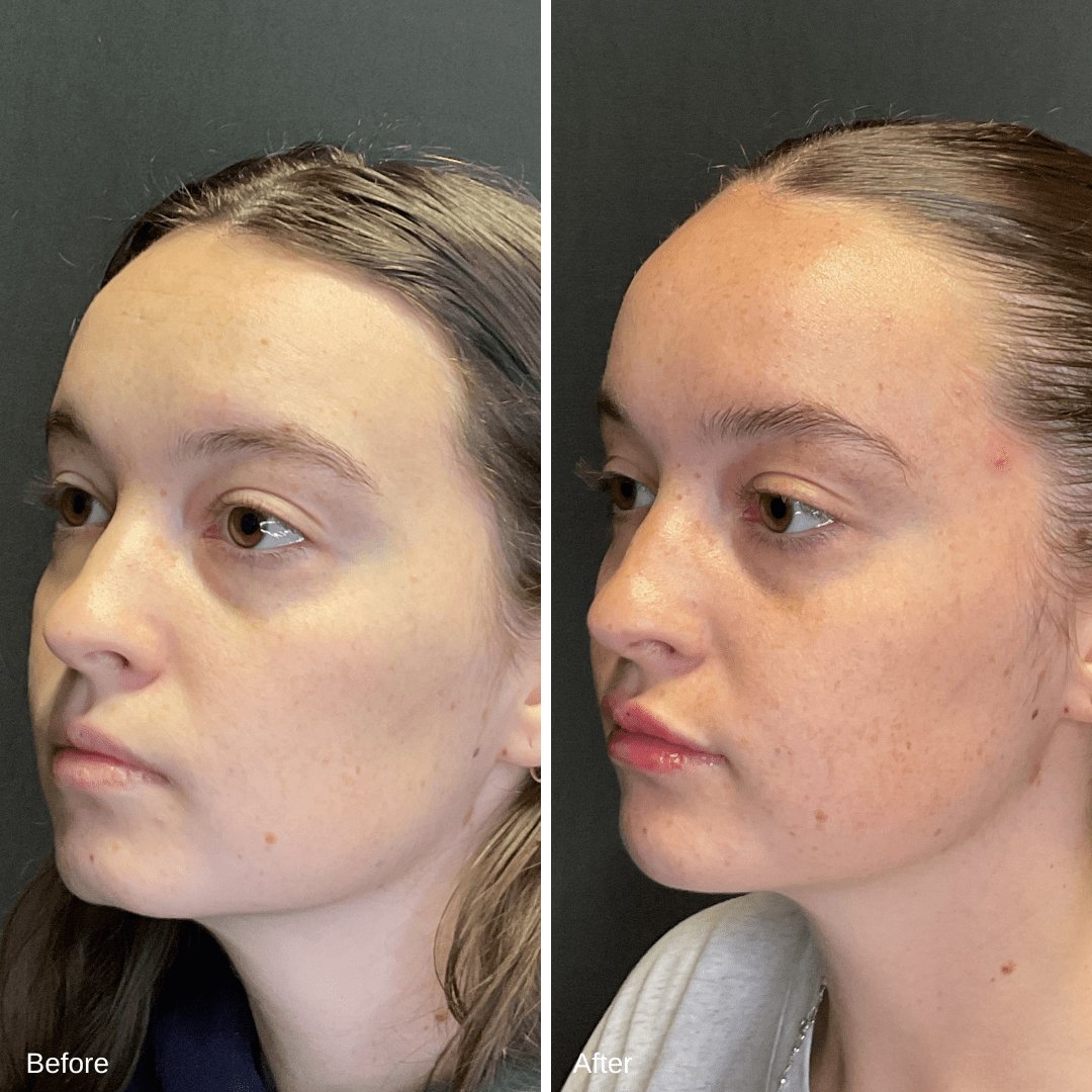 Filler Lips and Chin Oblique
