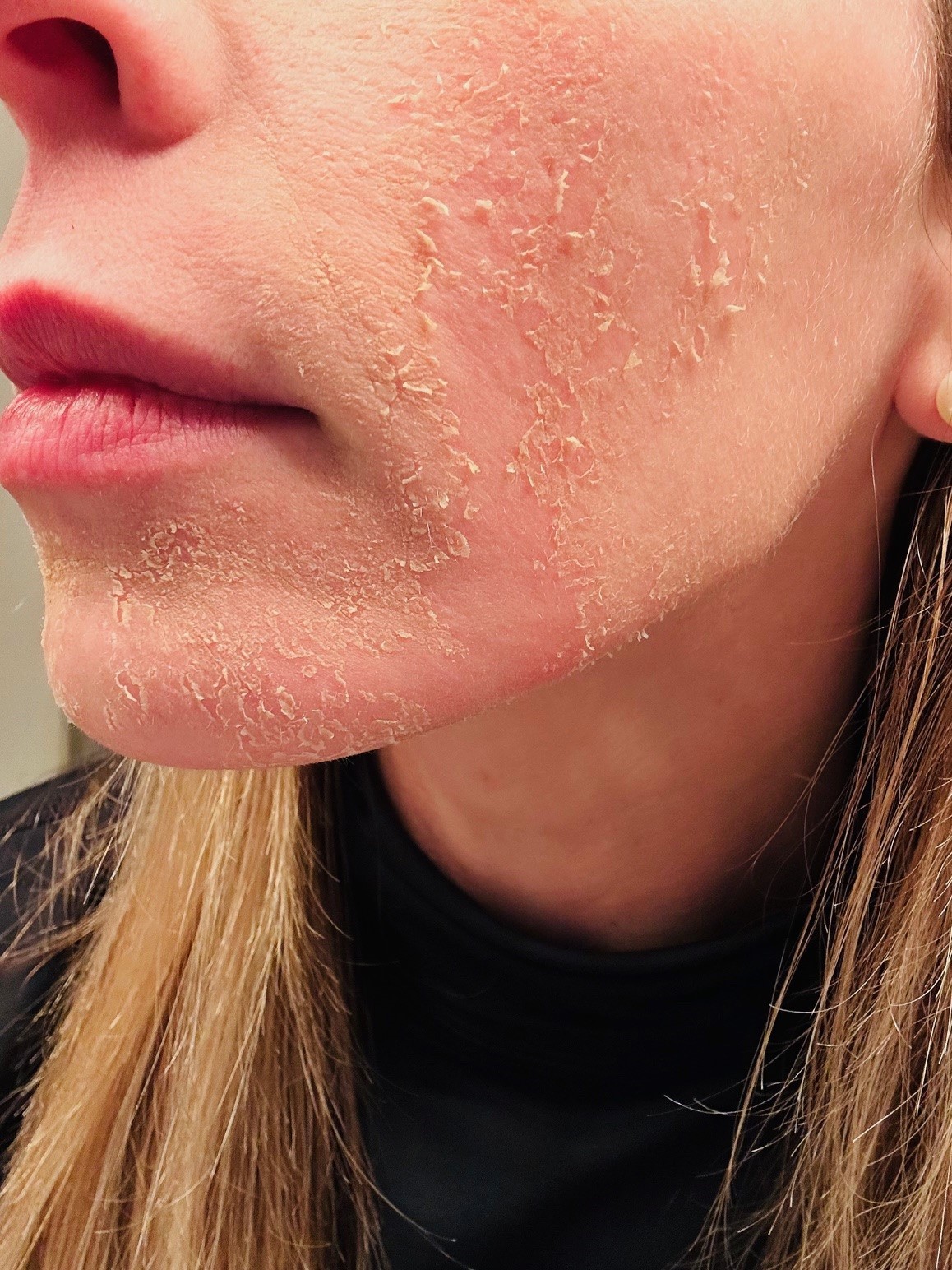 Chemical Peels