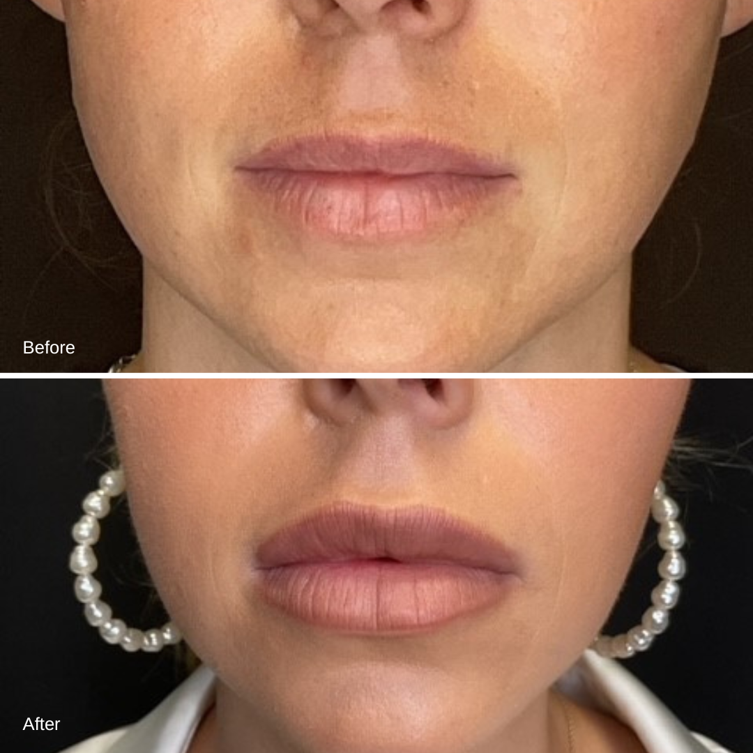 Lip Filler