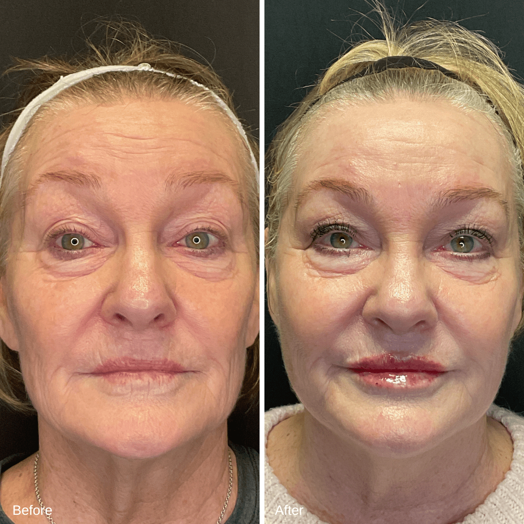 Denise Weber Filler