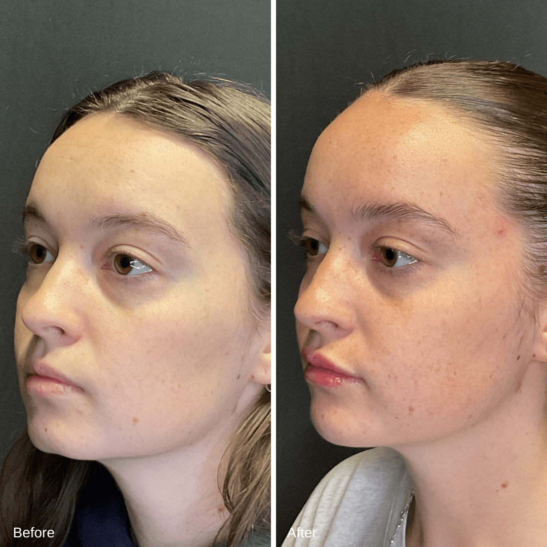 Filler Lips and Chin Oblique