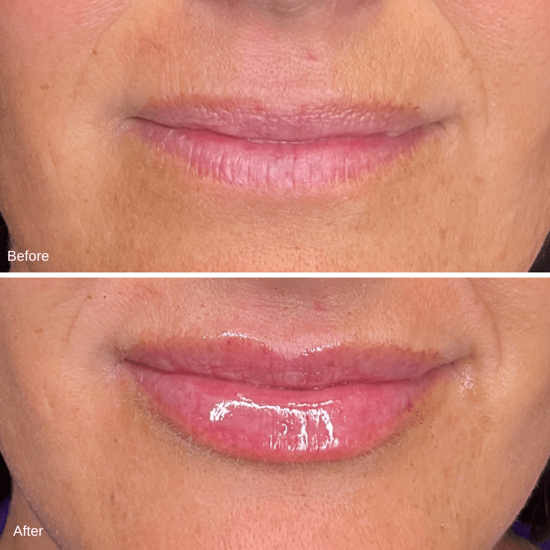 Lip Filler RHA2