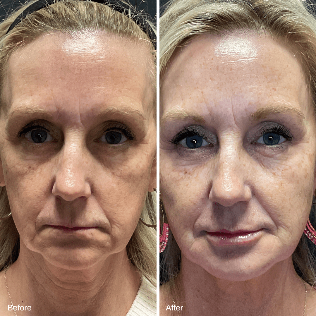 Full Face Filler