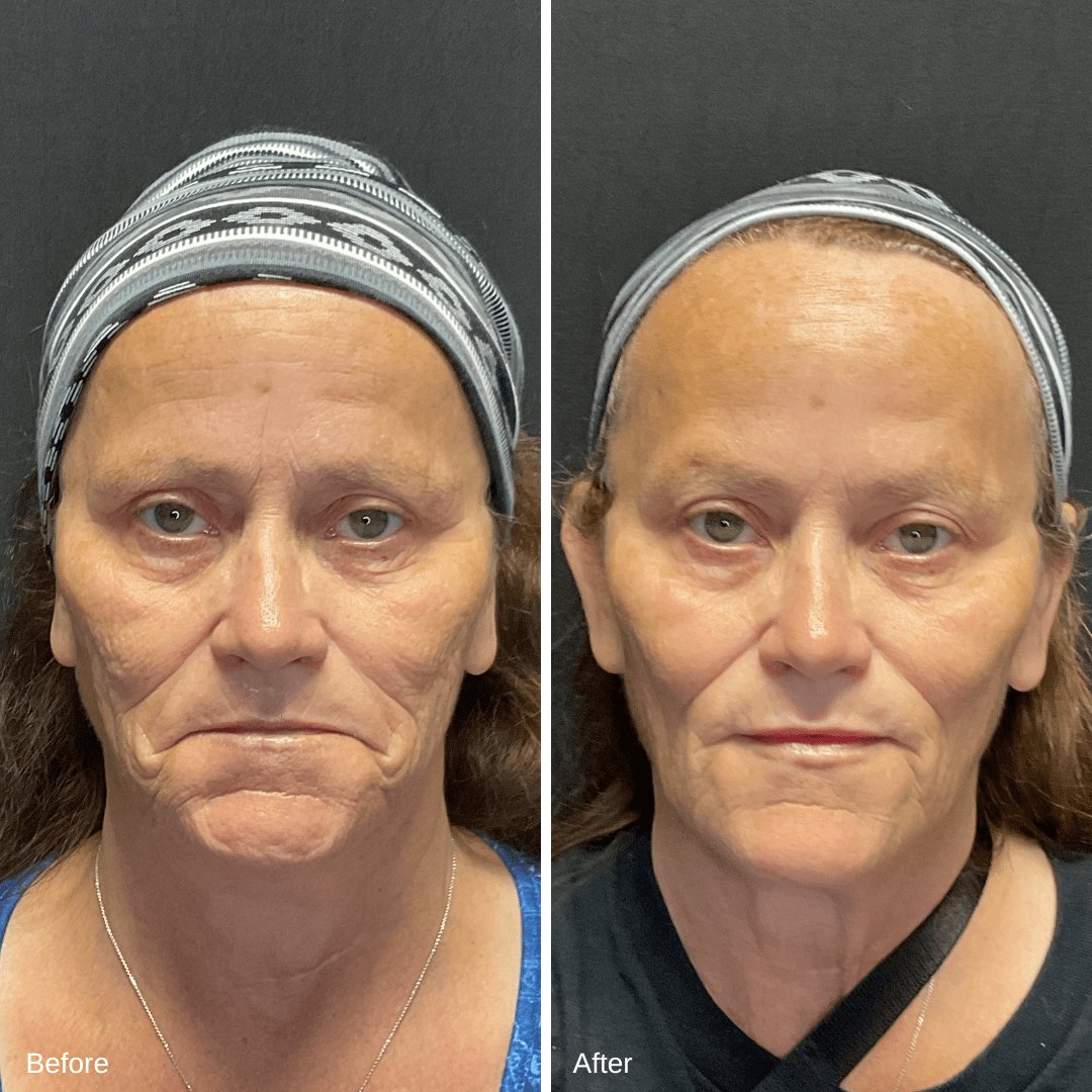 Patricia Depoorter Filler Dysport