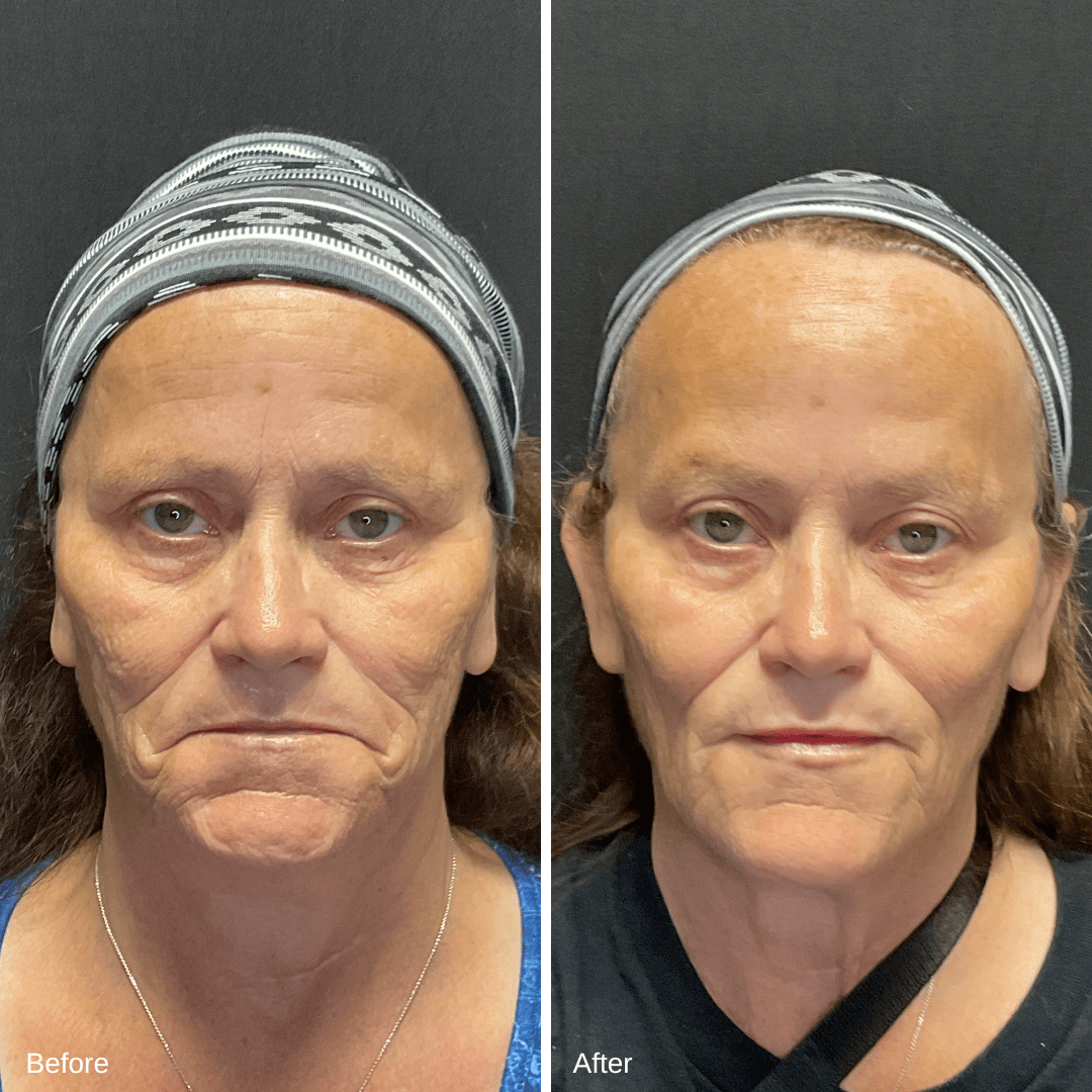 Patricia Depoorter Filler Dysport