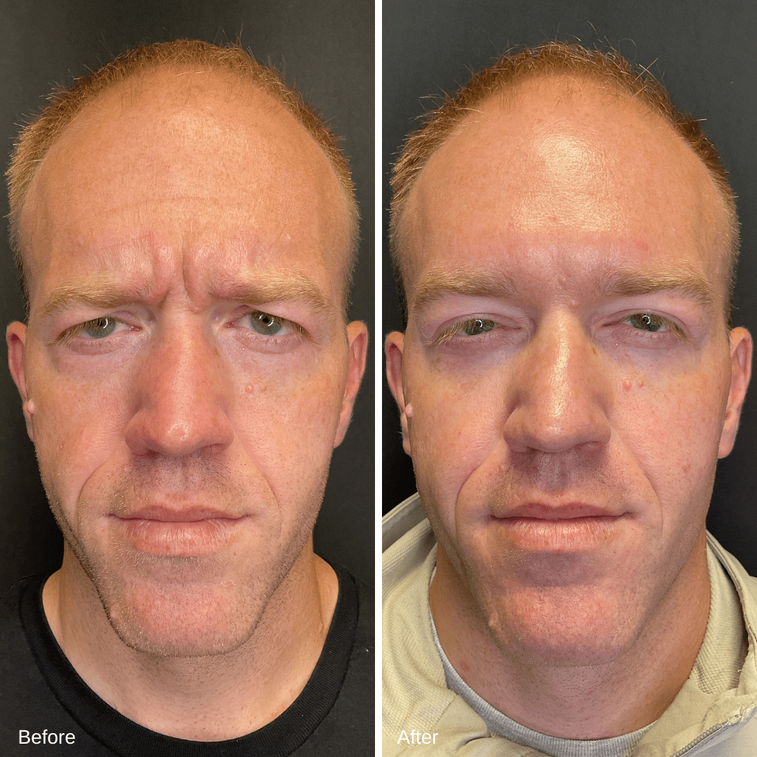 Dysport Before and After 1