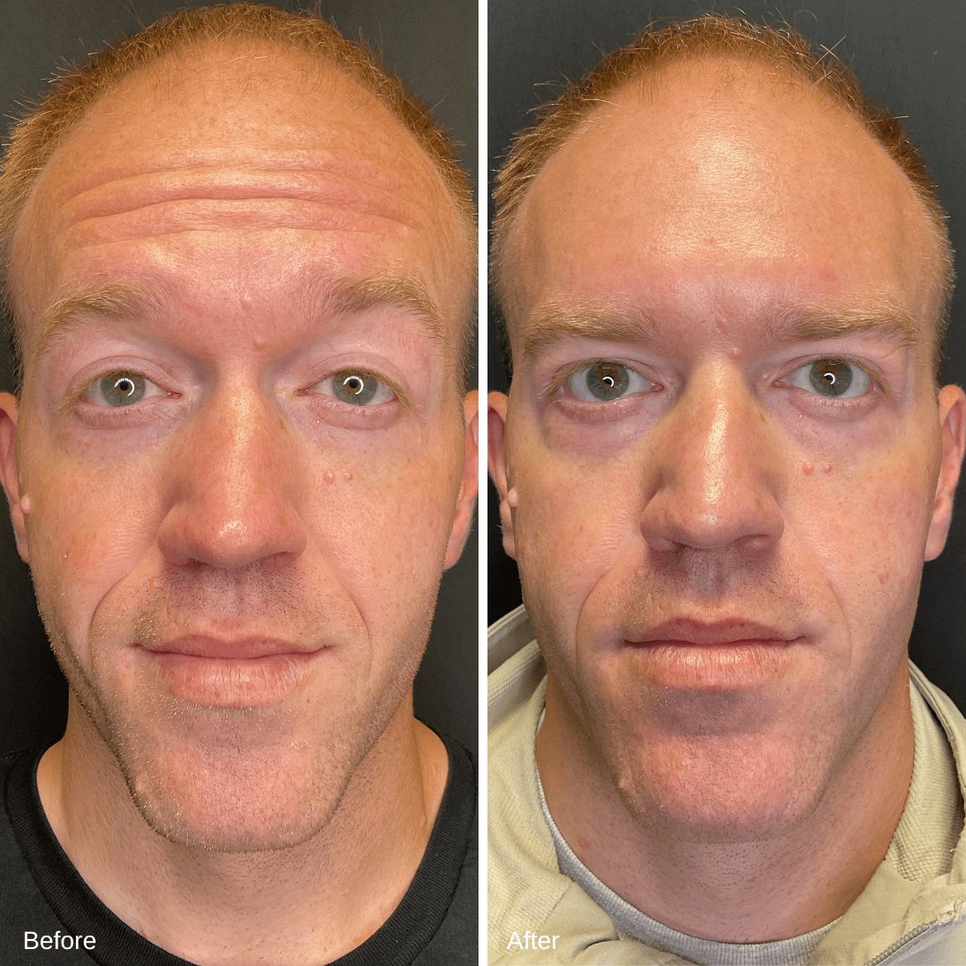 Dysport Before and After 2