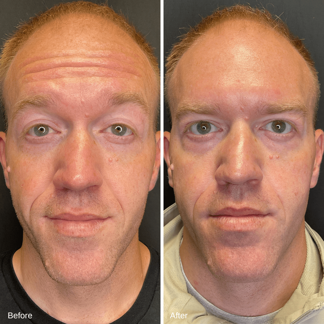 Dysport Before and After 2