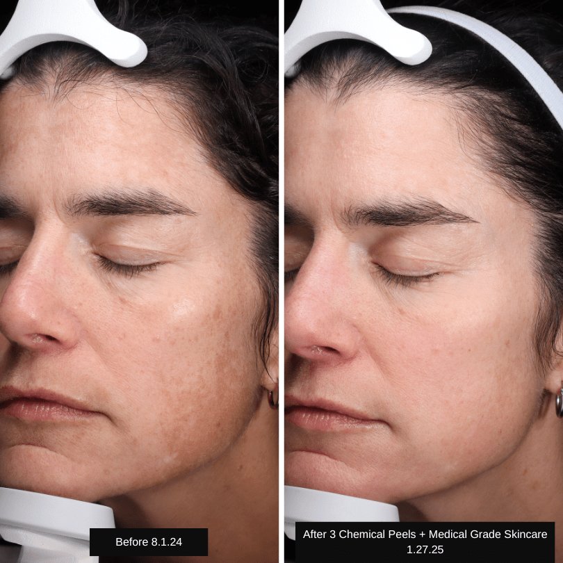 AB Chemical Peels Before and After