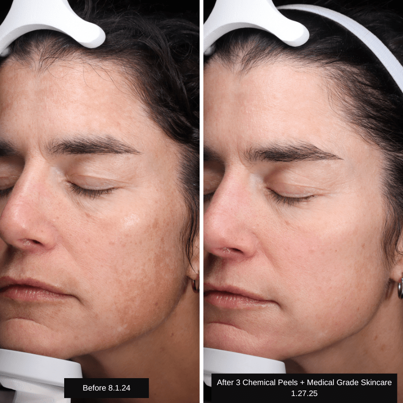 AB Chemical Peels Before and After