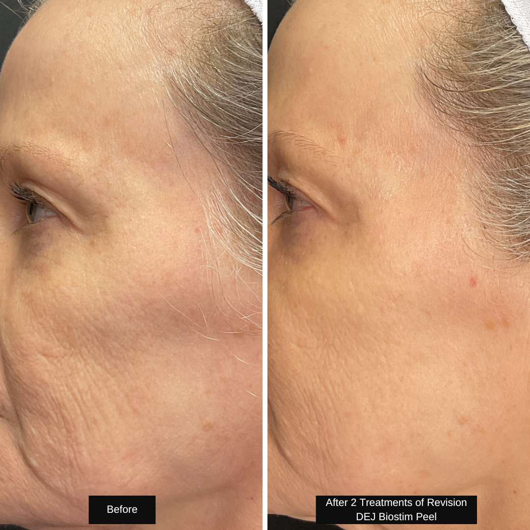 KZ DEJ BioStim Peel